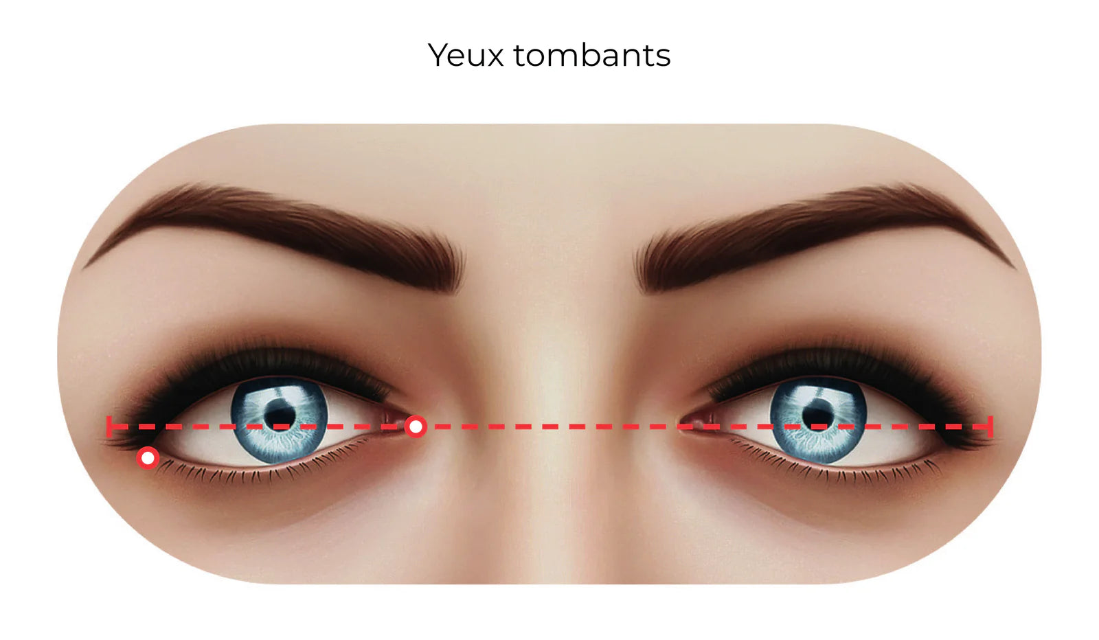 Yeux tombants